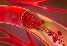 VENÖZ TROMBOEMBOLİDE HİPERKOAGUBİLİTE TESTLERİ